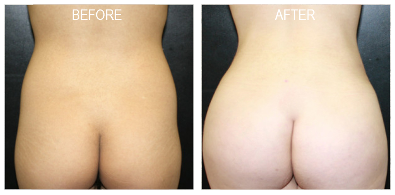 Brazilian Butt Lift Beverly Hills, BBL Surgery Los Angeles