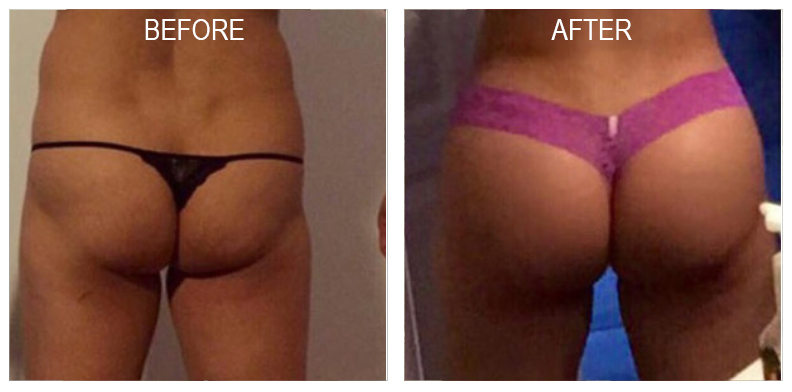 Dr. Kenneth Hughes, Brazilian Buttlift Los Angeles