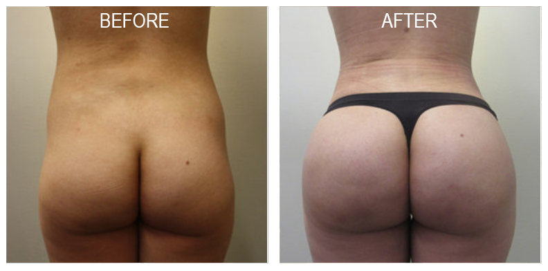 Get The Perfect Shaped Butts With BBL (Brazilian Butt Lift) Surgery:, by  Kane howard