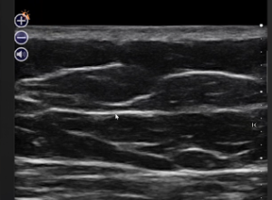 Brazilian buttlift injection in Los Angeles and Beverly Hills and corresponding ultrasound images - arrow at level of SFS (superficial fascial system)