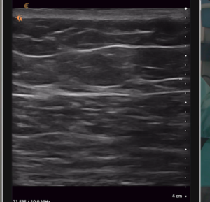 Brazilian buttlift injection and corresponding ultrasound images - with fat injected deep to the superficial fascial system (SFS) 