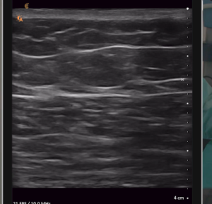 Brazilian buttlift Los Angeles and Beverly Hills and corresponding ultrasound images - fat injected deep to the SFS (superficial fascial system)