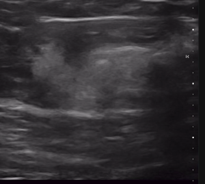 Brazilian buttlift injection and corresponding ultrasound images - with fat injected deep to the superficial fascial system (SFS) and superficial to the SFS